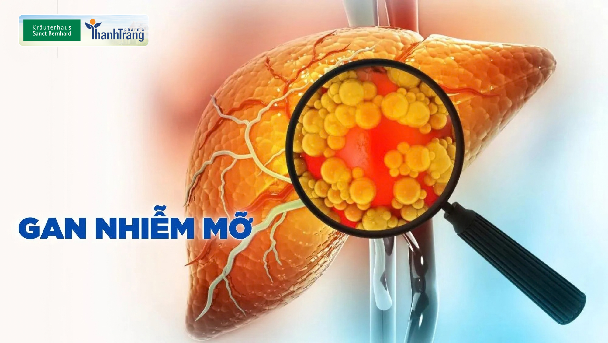 Gan nhiễm mỡ có nguy hiểm không? Nguyên nhân và cách phòng ngừa
